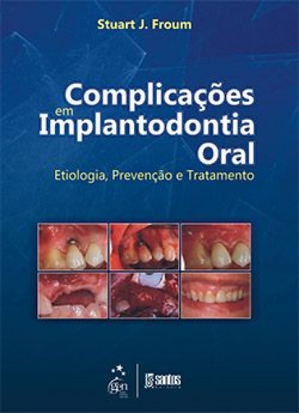 Complicações Em Implantodontia Oral - Etiologia, Prevenção E Tratamento