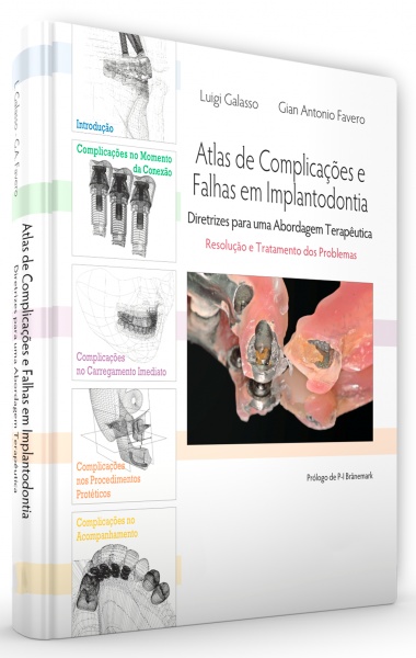 Atlas De Complicações E Falhas Em Implantodontia