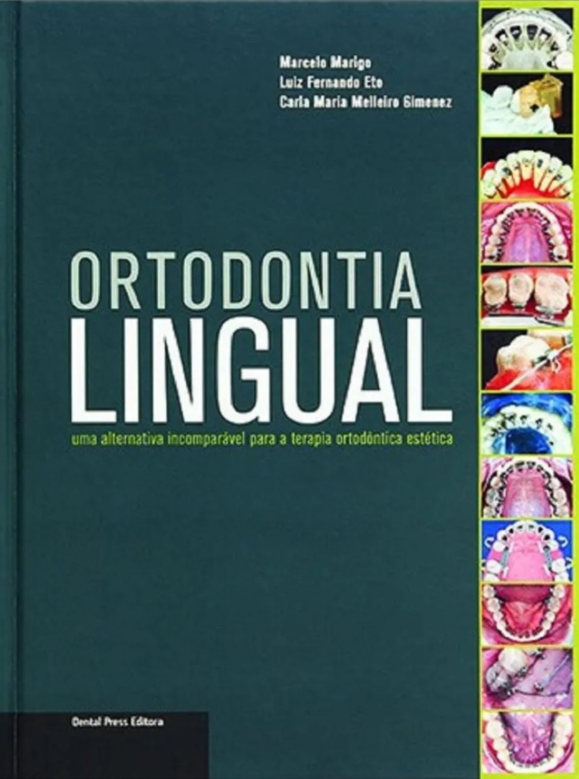 Ortodontia Lingual