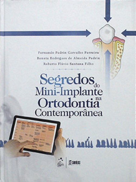 Segredos Do Mini-Implante Na Ortodontia Contemporânea 