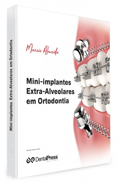 Mini-Implantes Extra-Alveolares Em Ortodontia