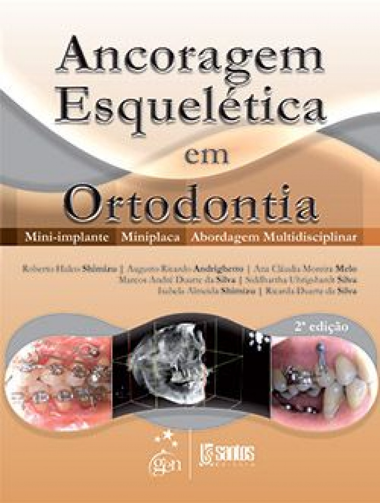 Ancoragem Esquelética Em Ortodontia - Mini-Implante - Miniplaca - Abordagem Multidisciplinar