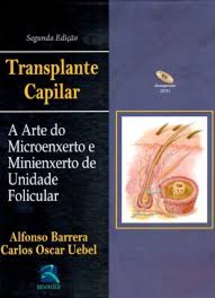 Transplante Capilar - A Arte Do Microenxerto E Minienxerto De Unid Folicula