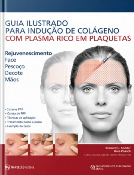 Guia Ilustrado Para Indução De Colágeno Com Plasma Rico Em Plaquetas