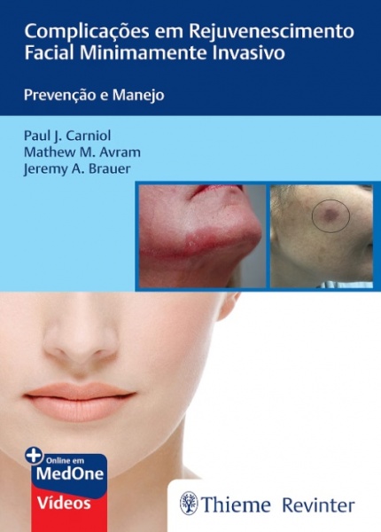 Complicações Em Rejuvenescimento Facial Minimamente Invasivo - Prevenção E Manejo