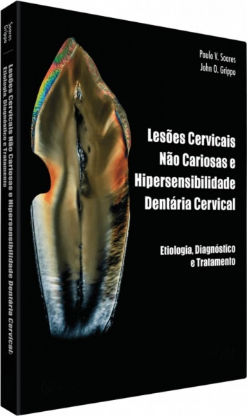 Lesões Cervicais Não Cariosas E Hipersensibilidade Dentinária Cervical - Etiologia, Diagnóstico E Tratamento