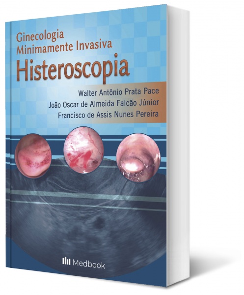 Histeroscopia – Ginecologia Minimamente Invasiva