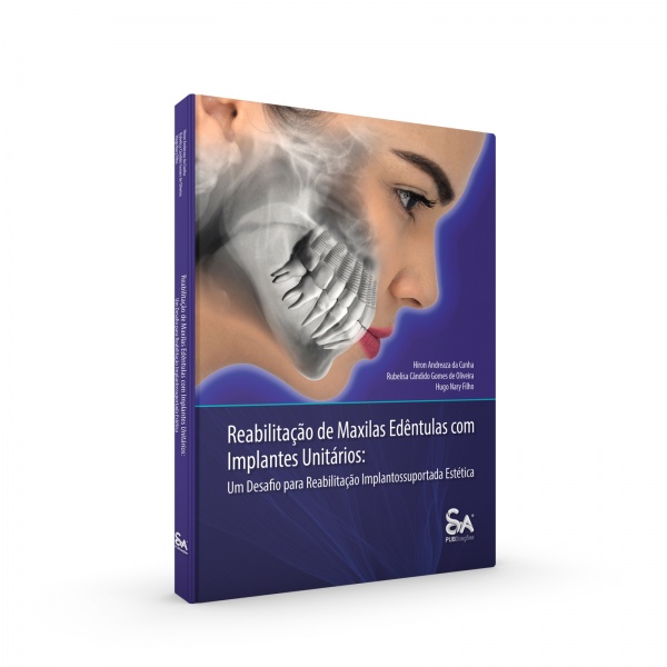 Reabilitação De Maxilas Edêntulas Com Implantes Unitários: Um Desafio Para Reabilitação Implantossuportada Estética