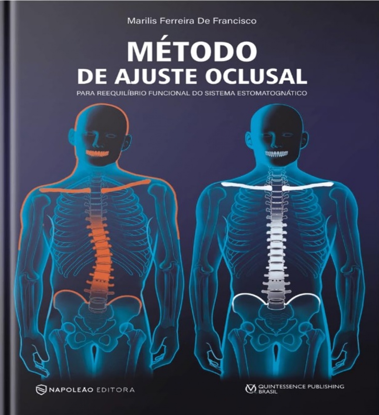 Método De Ajuste Oclusal Para Reequilíbrio Funcional Do Sistema Estomatognático