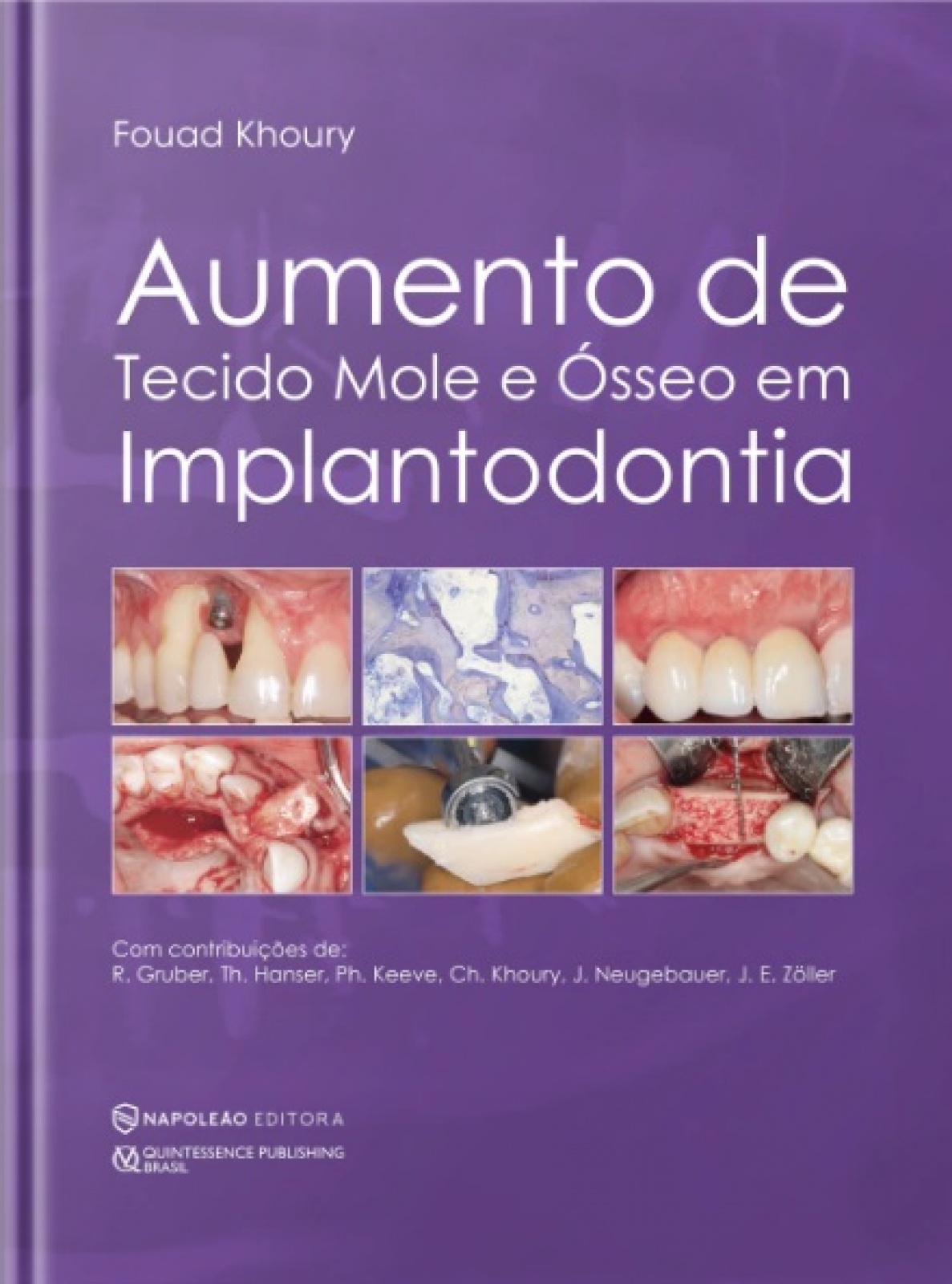 Aumento Ósseo E Tecido Mole Em Implantodontia