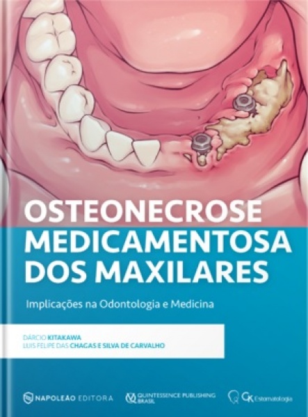 Osteonecrose Medicamentosa Dos Maxilares 