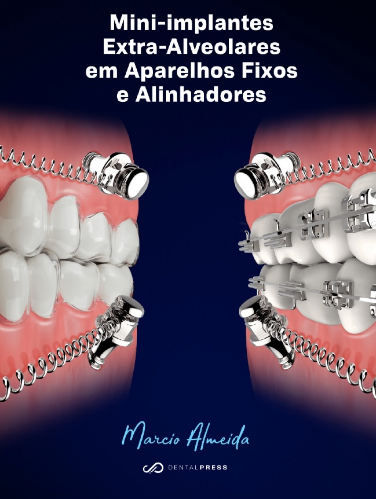 Mini-Implantes Extra-Alveolares Em Aparelhos Fixos E Alinhadores