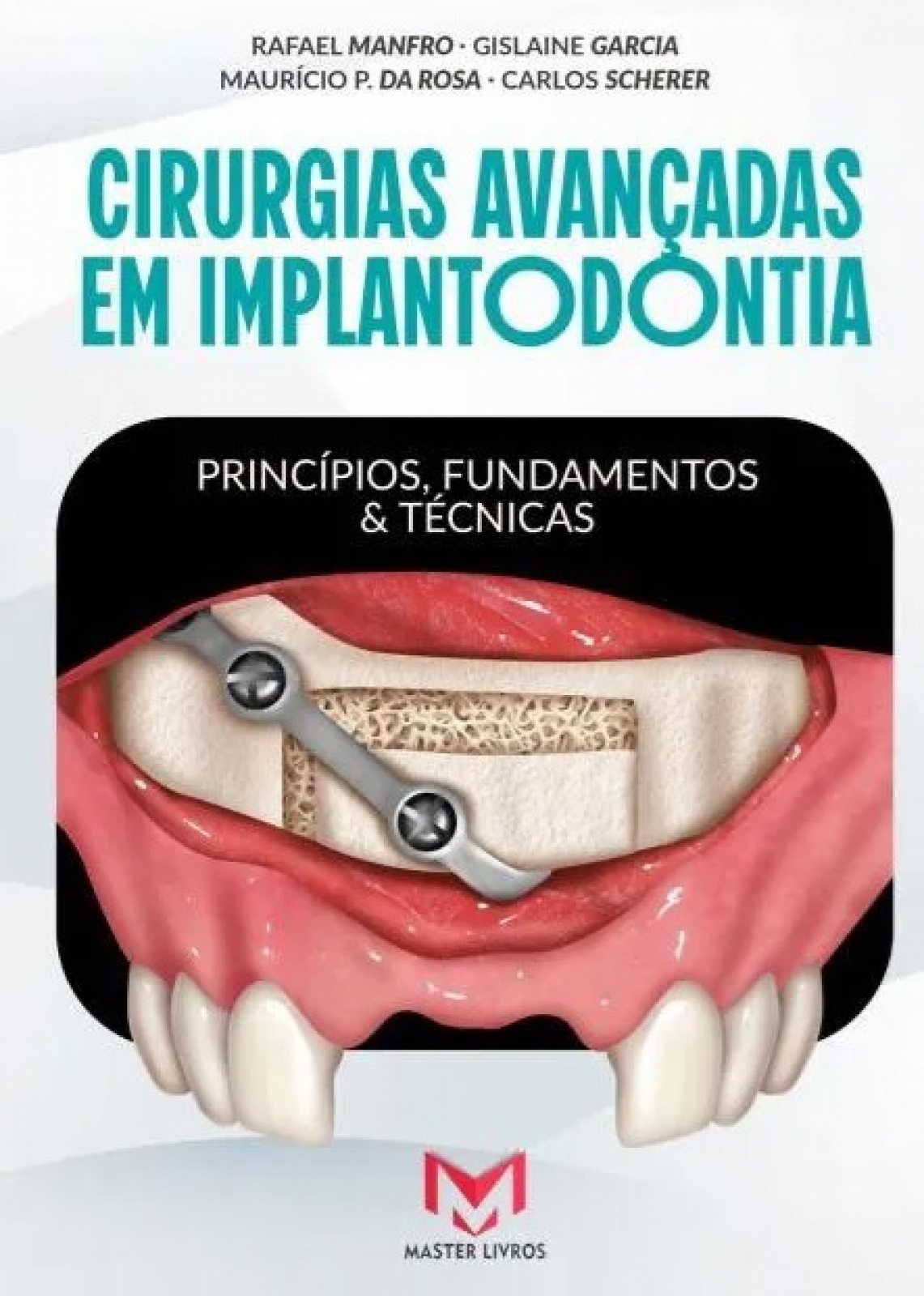 Cirurgias Avançadas Em Implantodontia - Princípios, Fundamentos E Técnicas