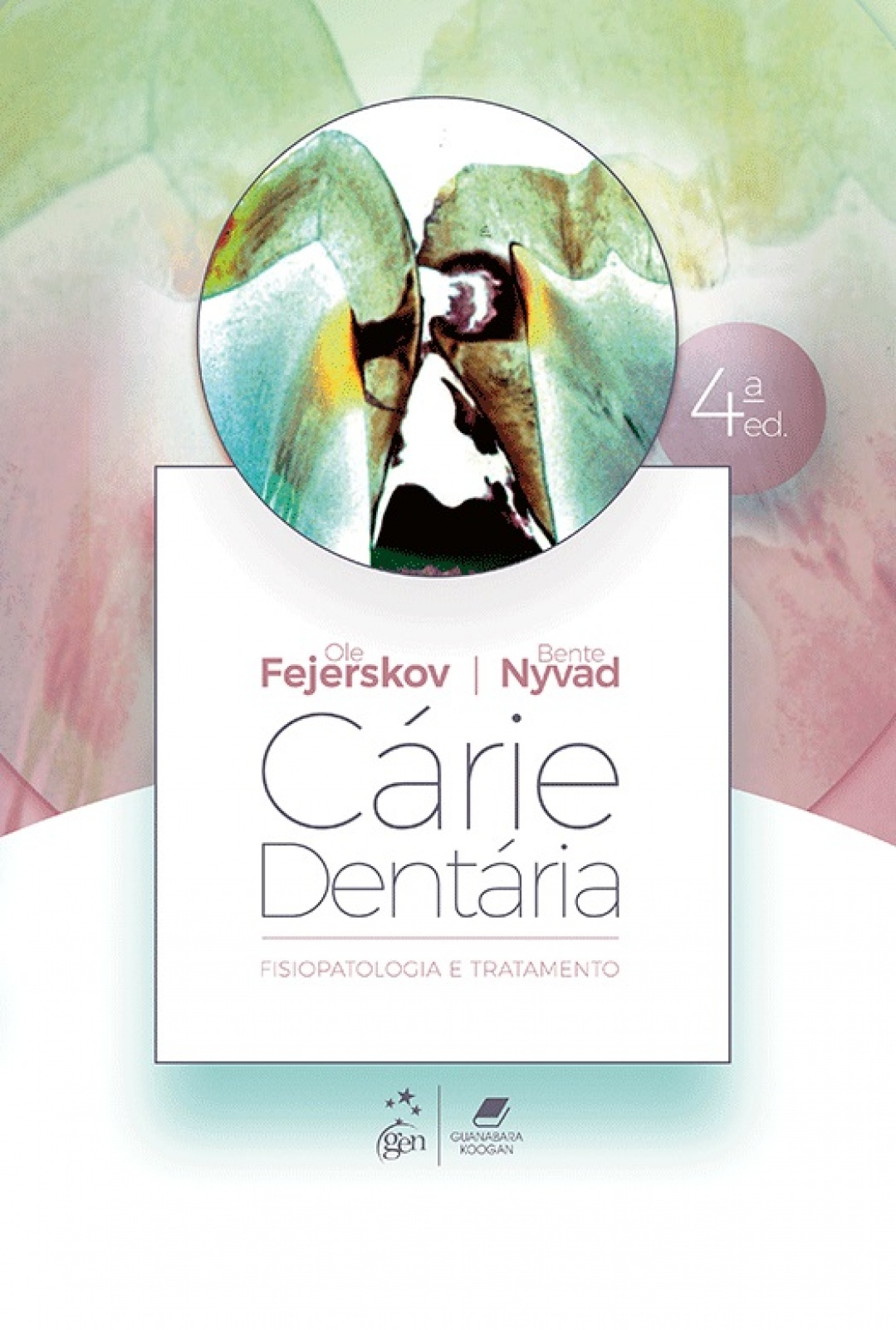 Cárie Dentária: Fisiopatologia E Tratamento